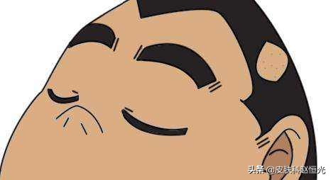 斑秃多久会好如何有效治疗斑秃,斑秃症状揭秘如何识别并治疗斑秃