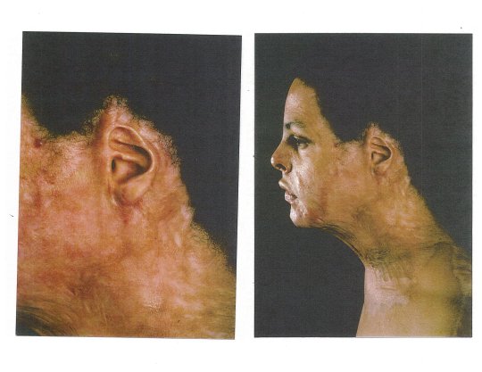 美国高中生意外受伤,美国少年被烧伤