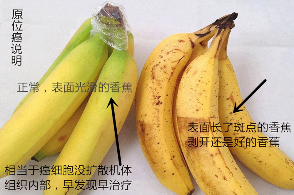 以原位癌为主的浸润癌预后怎样,原位癌伴微浸润如何治疗