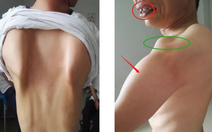 进行性肌营养不良的中医治疗,进行性肌营养不良中医中药配方