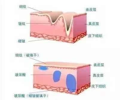脸上干纹细纹多怎么办,怎样改善脸上的干纹和细纹