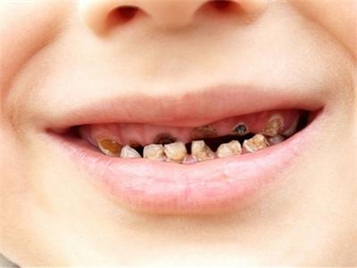 乳牙蛀掉只剩牙根影响恒牙萌出吗,乳牙蛀了要不要做根管