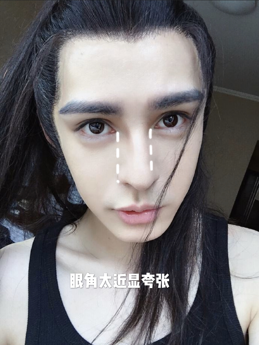 眼角开的形状不自然能修复么,眼角开大了恢复后会变小吗