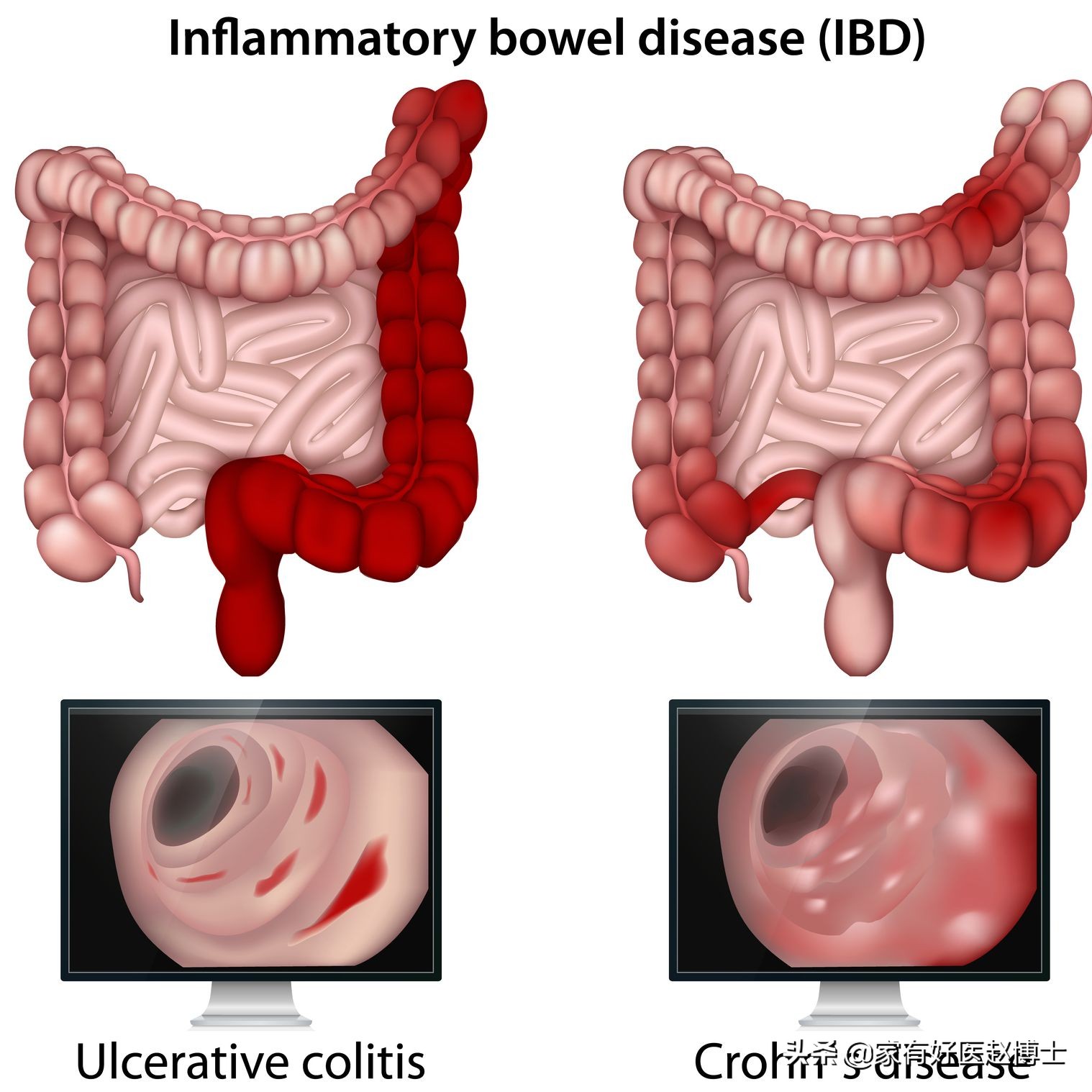 患癌最多的疾病以及预防,四种高致癌性炎症