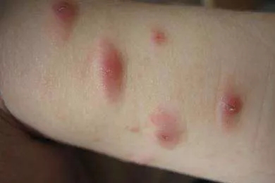 每天睡觉前出荨麻疹什么原因,每日一招如何有效预防麻疹