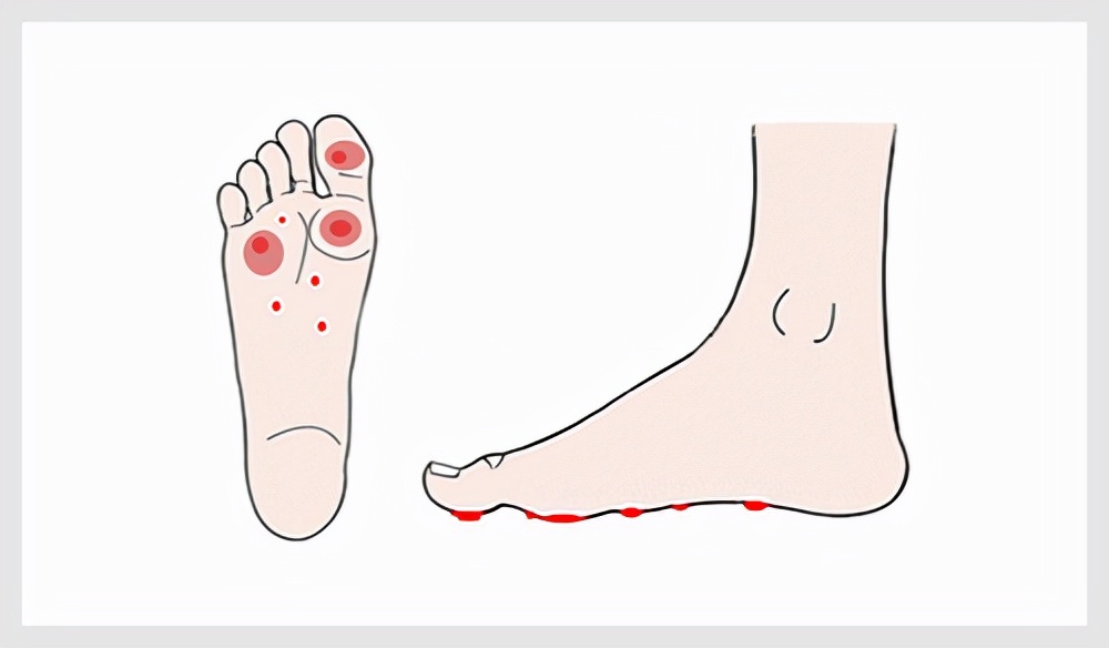 脚上的跖疣是瘊子吗,跖疣和刺瘊怎么感染的