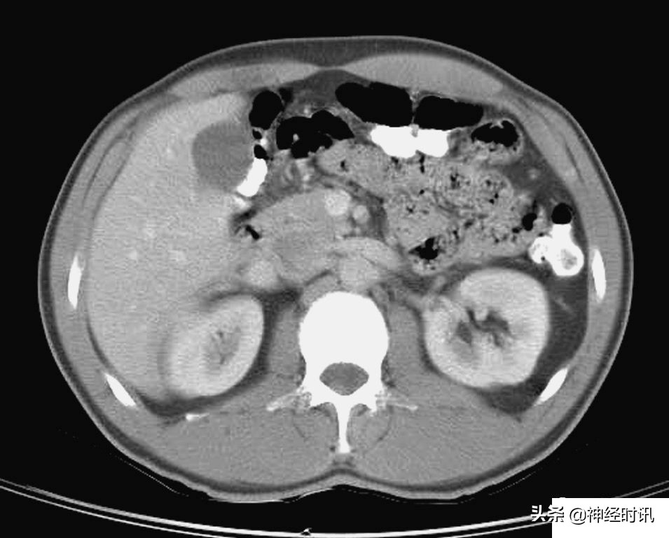 肾脏输尿管膀胱前列腺结构,肾输尿管膀胱解剖示意图