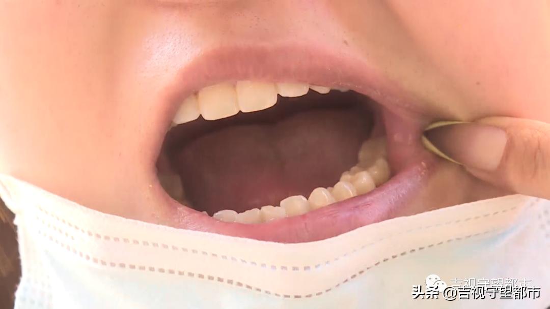 烤瓷牙里都烂成渣渣了,烤瓷牙太厚了要重新做吗