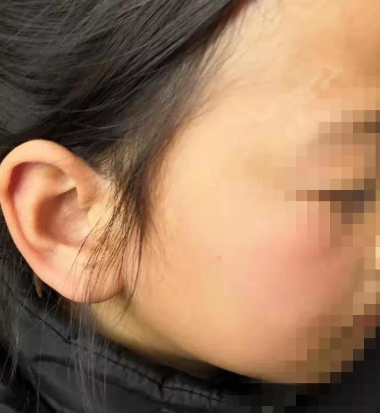 治疗白癜风中医好还是西医好,治疗白癜风中医好还是西医效果好