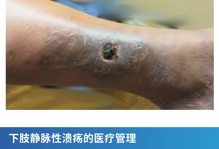 老烂腿溃疡化脓,腿部溃疡老不好怎么可以治愈