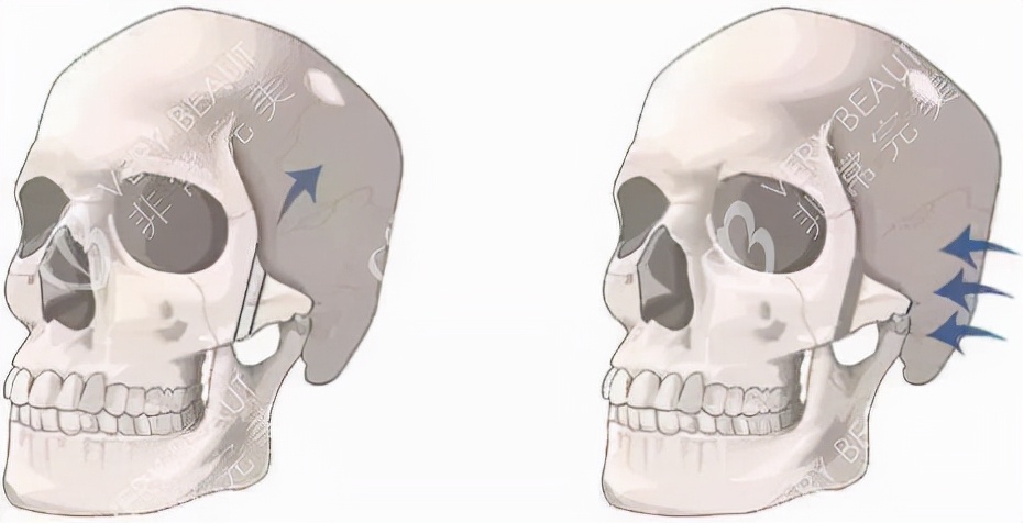 哪个明星做了颧骨内推,颧骨内推明星前后对比