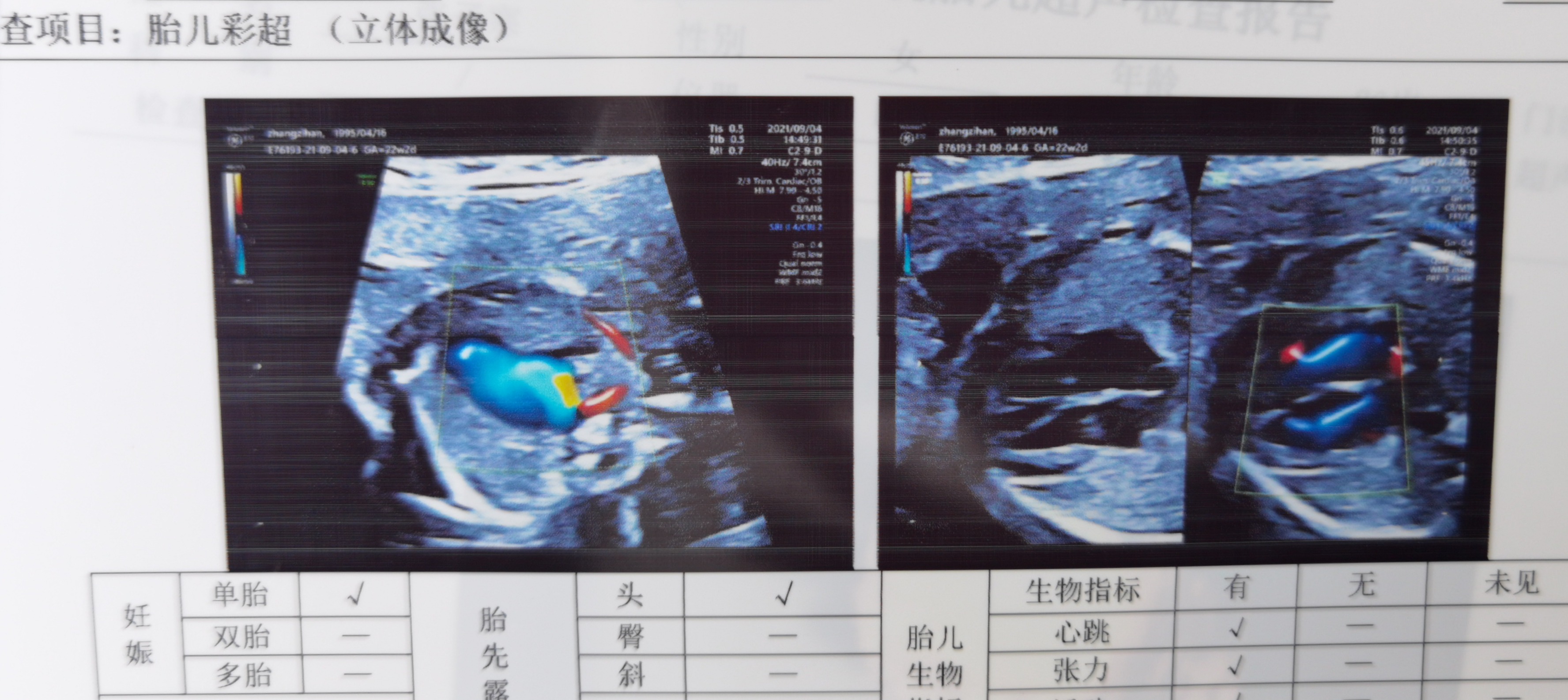 彩超显示动脉血管闭塞,产检发现胎儿迷走右锁骨下动脉