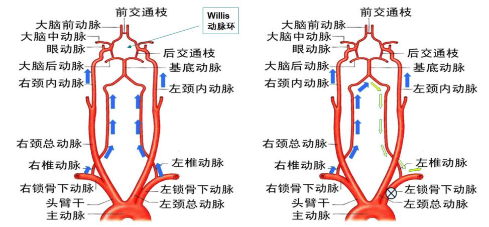 左锁骨下动脉闭塞会引起高血压吗,锁骨下动脉狭窄血压高还是低