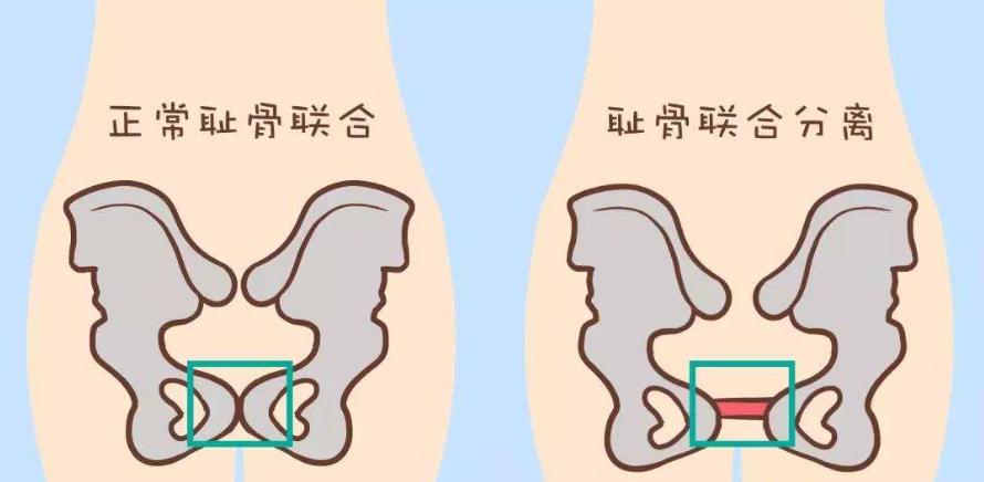 月子期间的腰腿痛怎么治疗,女人生完孩子腰腿一直疼