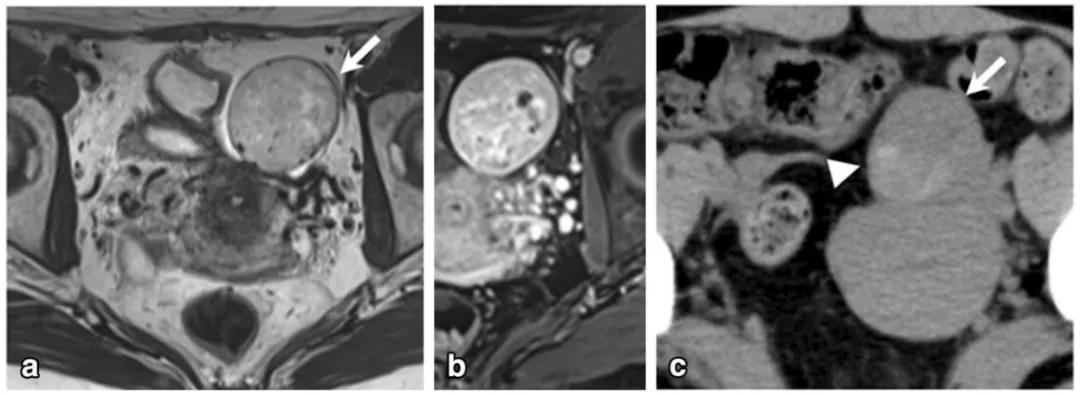 卵巢实性为主肿瘤，这13种你都想到了吗？
