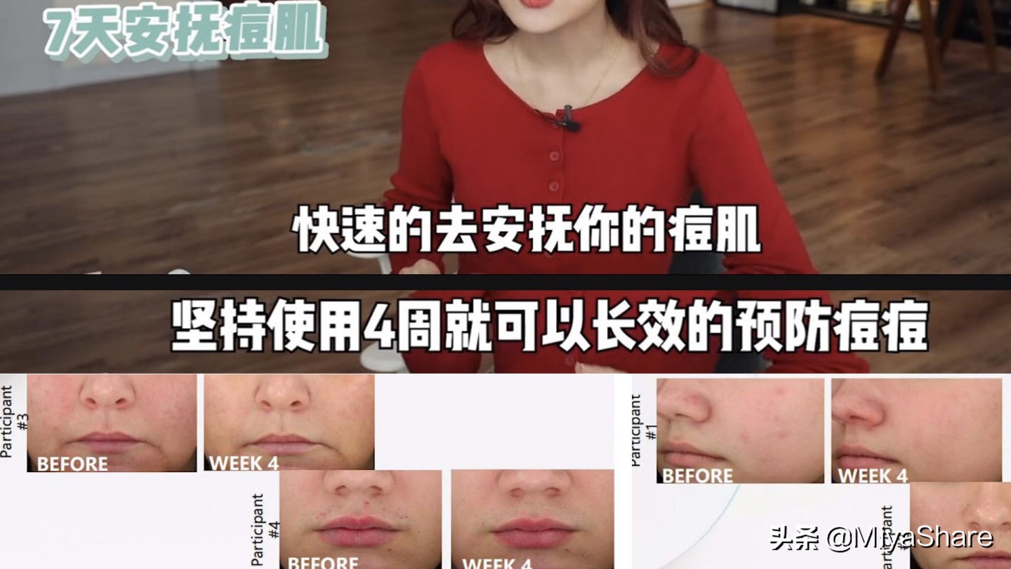 痘肌用洗面奶洗脸是不是长痘,长痘肌应该频繁用洗面奶洗脸吗