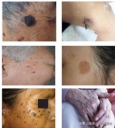 老年斑的形成原因及预防方法,最近老年斑越来越多什么原因