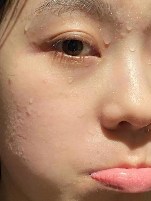 痘痘反反复复又红又疼又痒,痘痘反反复复有一层皮