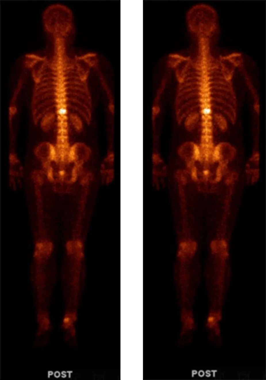 前列腺癌转移骨髓瘤治愈经验,前列腺癌骨转移抗癌成功案例