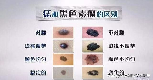 激光点痣适合多大的痣,激光点痣以后痣晕开了怎么办