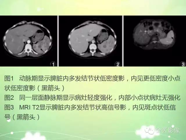 脾血管瘤中医辨证,脾血管瘤超声表现