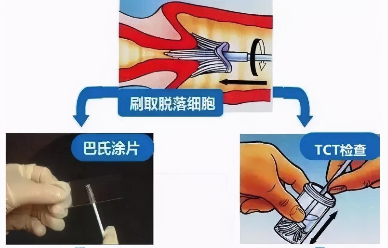 宫颈癌和宫颈糜烂症状一样不,宫颈糜烂与宫颈癌的症状区别