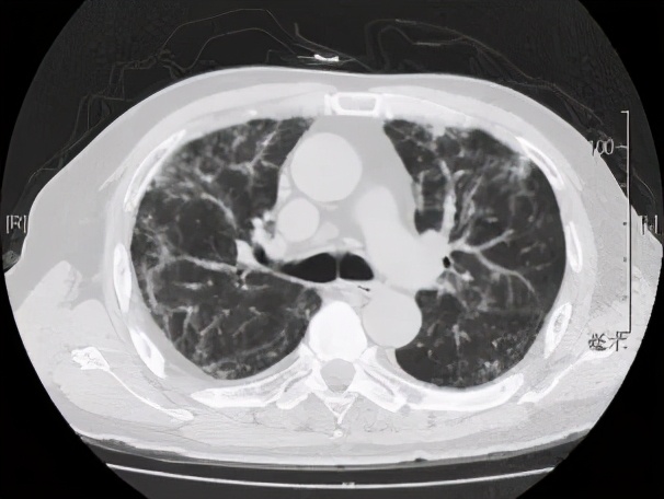 阵发性房颤和用药有关系吗,房颤药物控制好了还会复发吗