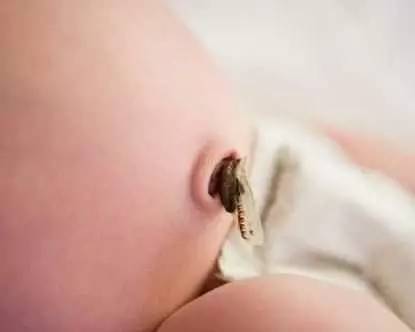 宝宝出生10天发现肺炎住院,宝宝一出生就得了败血症