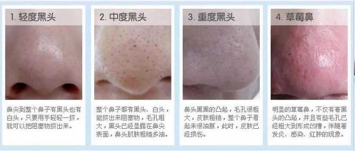 收缩毛孔最有效的方法非手术,收缩毛孔这3个办法真的很实用