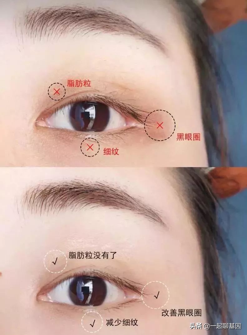 大眼袋眼纹抹平了,眼纹医美怎么去除