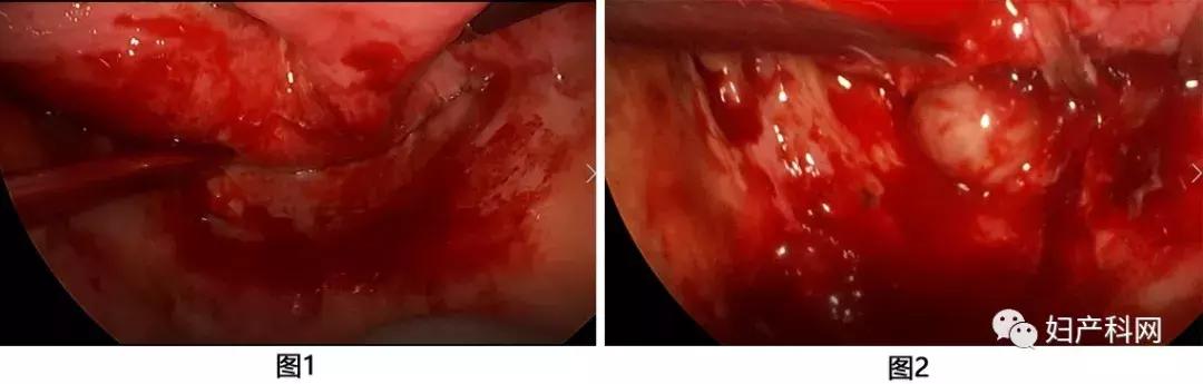 病例分析b型,盆腔脓肿完整病历书写