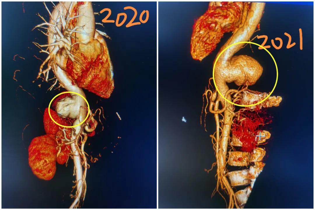 小伙被感染梅毒,感染梅毒胸口会不会不舒服