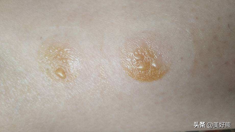 艾灸后感觉人瘦了,艾灸了一段时间人好像瘦了一圈