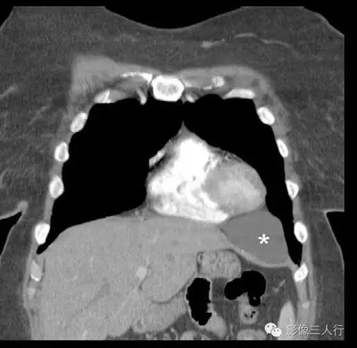 纵隔囊肿影像学表现,纵隔囊肿心包囊肿