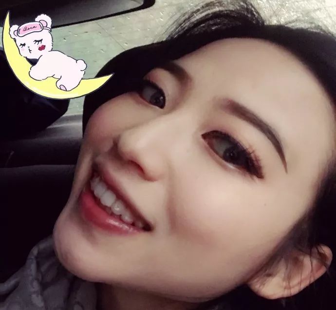 龅牙矫正前后对比照片,龅牙修复效果图