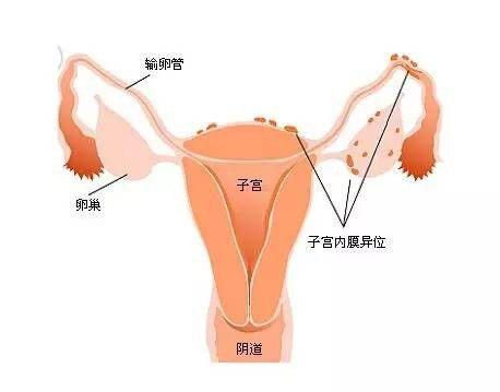 治好子宫腺肌症,子宫腺肌症该怎么彻底治好