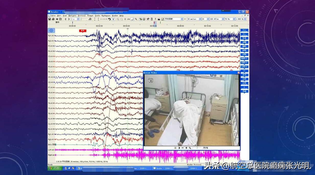 张光明左颞叶癫痫手术成功率,张光明谈治疗癫痫的方法有哪些