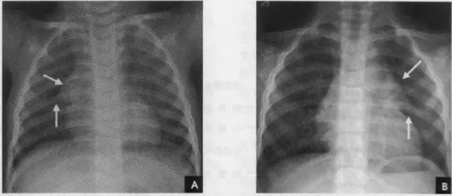 收藏：详细的胸部X线解剖，最基础最实用
