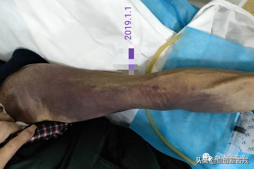 内瘘血肿,穿刺后皮下血肿怎么处理