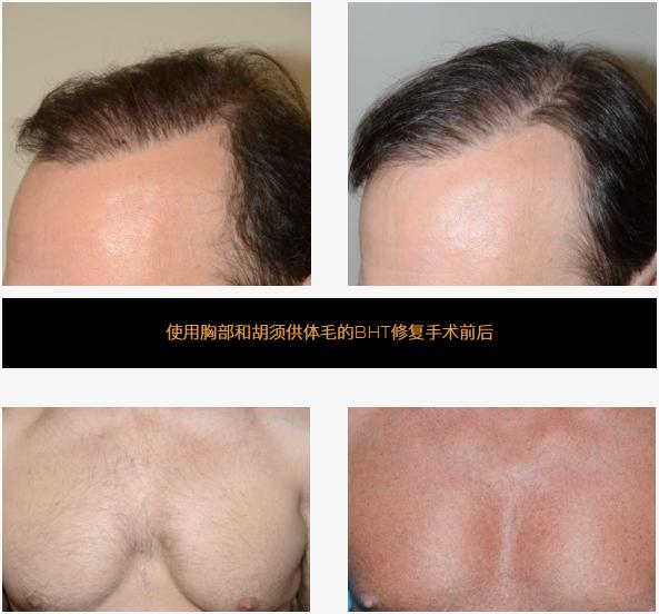 胸毛腿毛的毛囊能植发吗,胸毛可以用来植发嘛