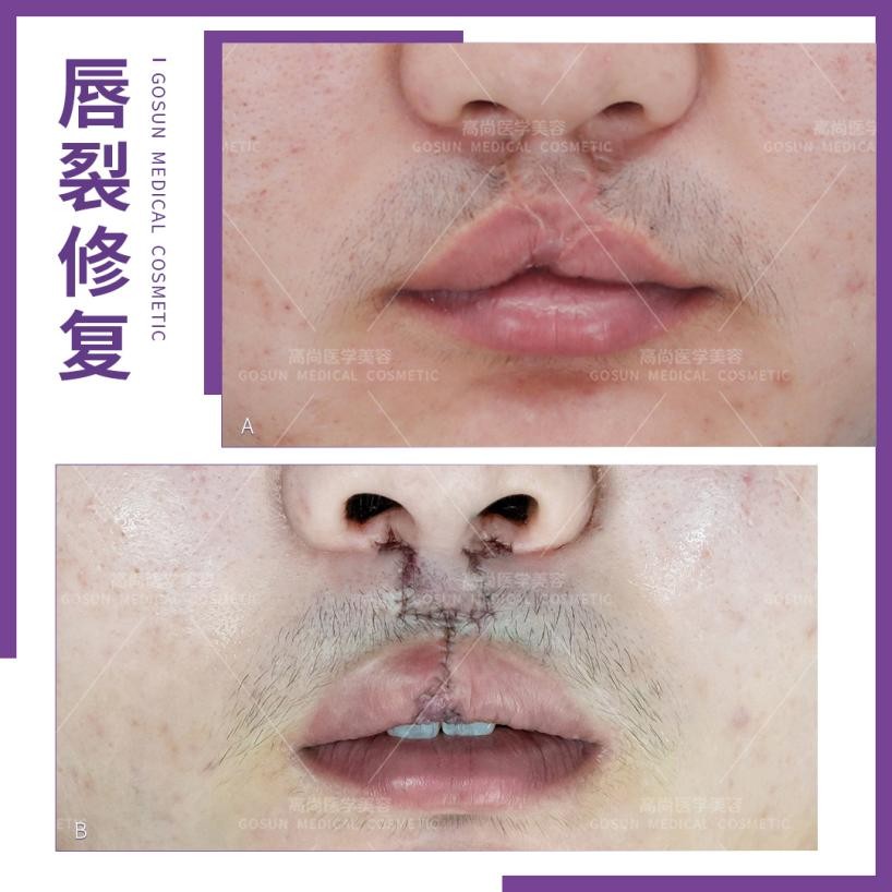 唇裂修复了还有疤痕影响嫁人吗,唇裂伤缝合后会有疤痕吗