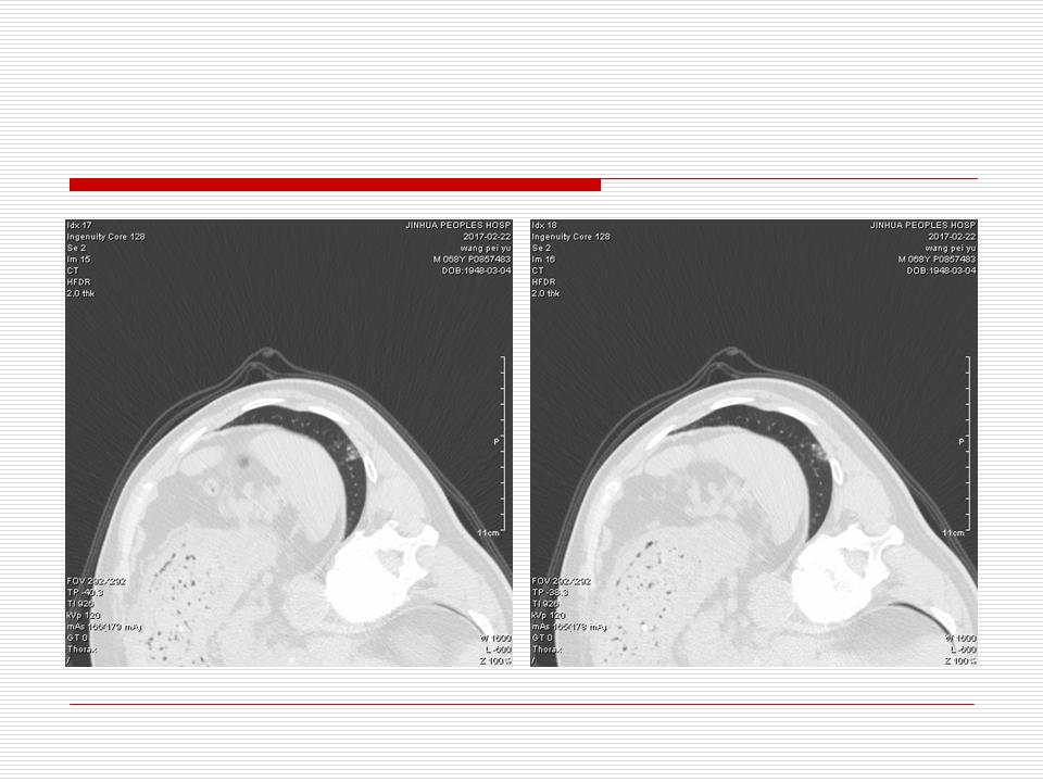 像炎症的肺癌能治好吗,医生说可能是肺癌也可能是炎症
