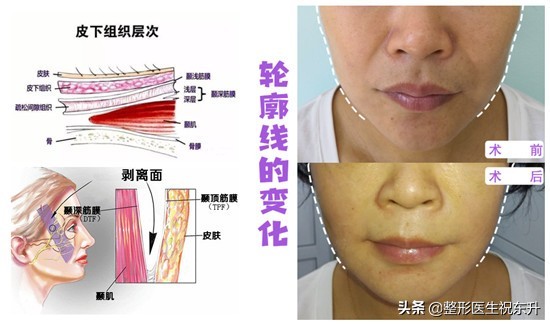 自体脂肪填充法令纹亲身经历,法令纹是不是出现了才能填充