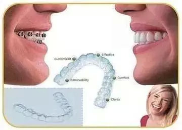 选择隐形牙套需要了解事项,隐形矫正佩戴注意事项