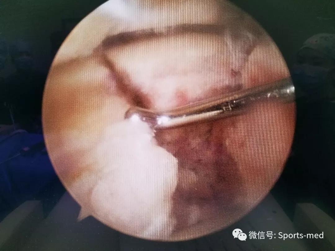 距骨软骨损伤的关节镜治疗,距骨软骨损伤关节镜手术