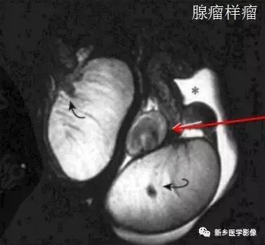 睾丸内部病变,睾丸病变mri