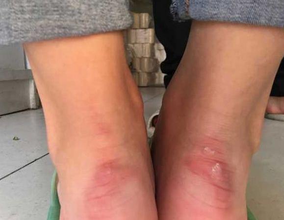 鞋子磨脚后跟怎么处理就不磨脚了,新鞋磨脚怎么办只需这几个小窍门