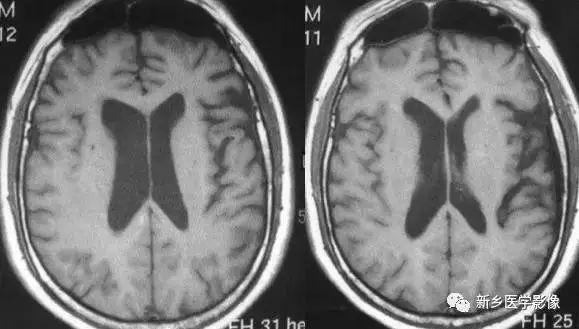 什么引起成人脑室扩大,哪些病可以导致左侧脑室增宽