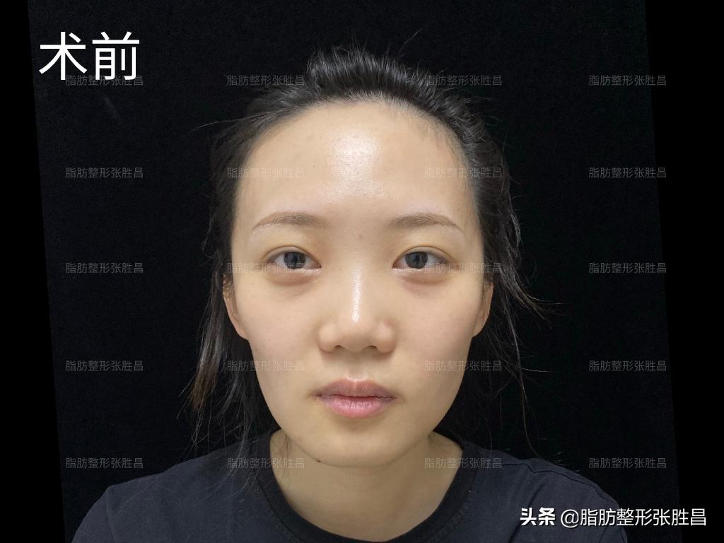 30岁龅牙矫正牙齿后脸型变化图,牙齿矫正使脸型凹陷会恢复吗