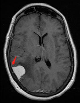 张医生大白话：一文读懂脑膜瘤